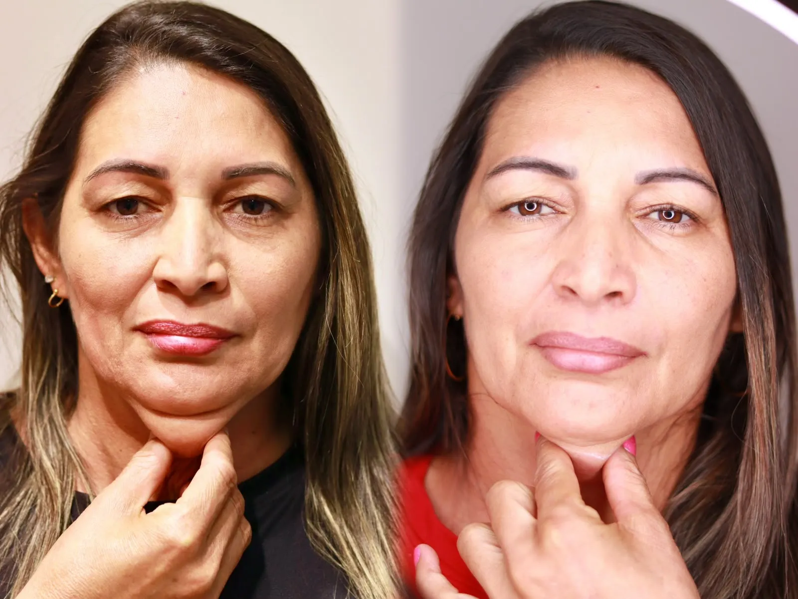 Antes e depois do contorno facial de paciente feminina, vista frontal