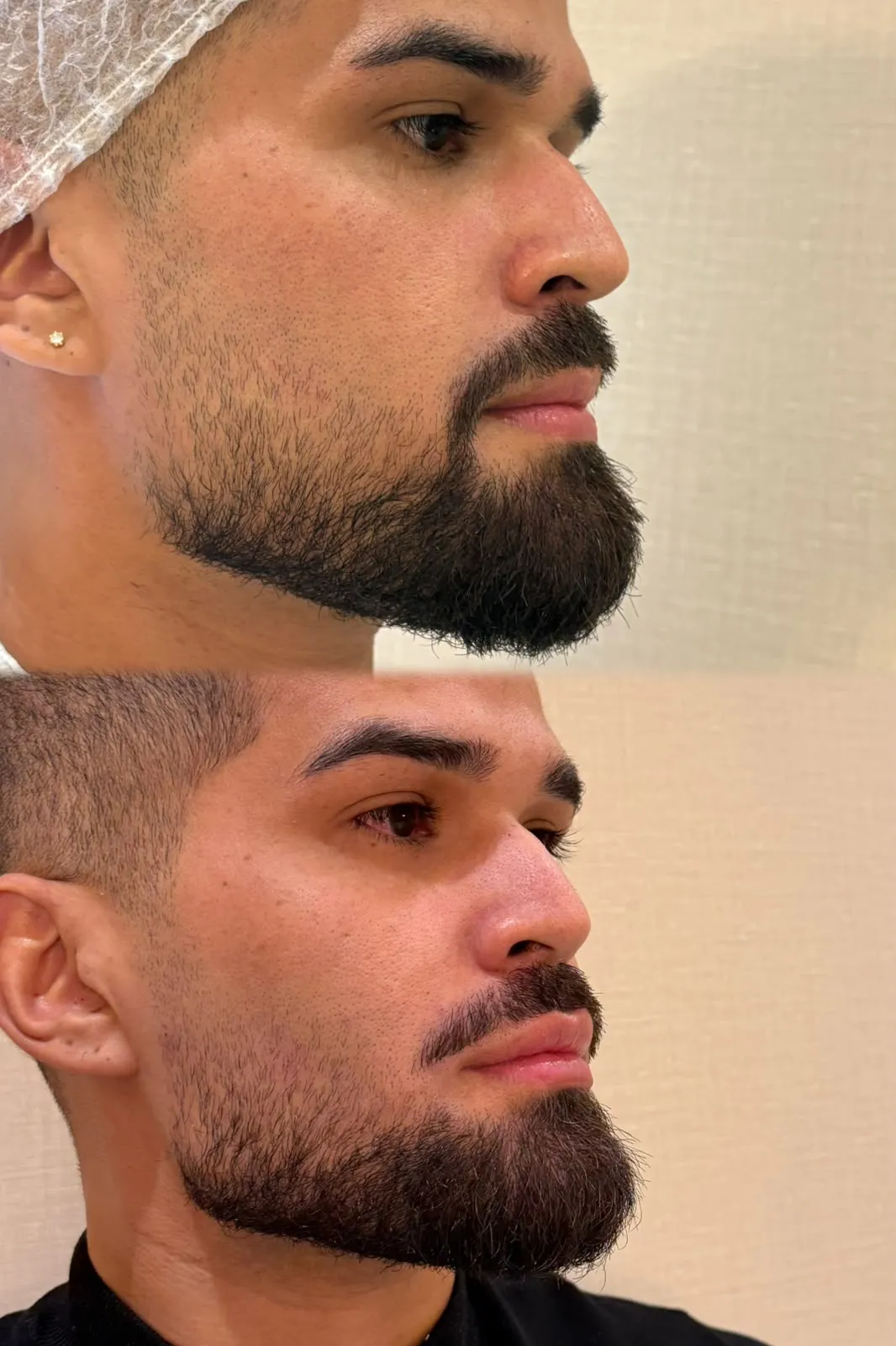 Antes e depois do contorno facial de paciente masculino, vista oblíqua