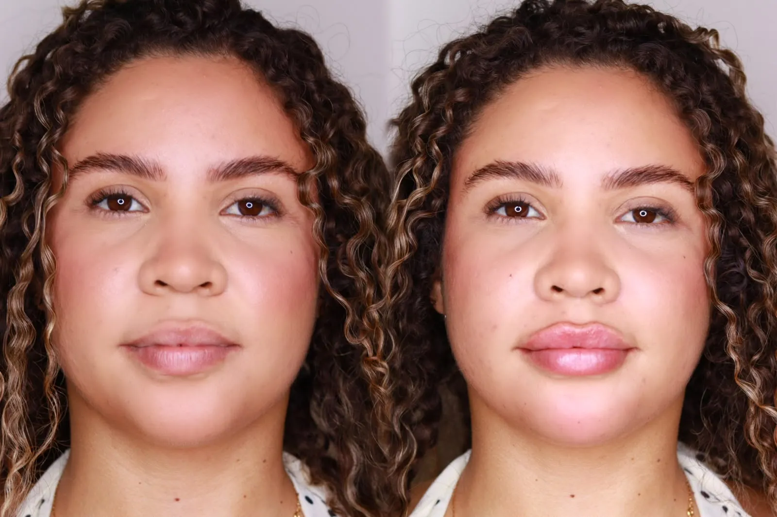 Antes e depois dos lábios de paciente feminina, vista frontal