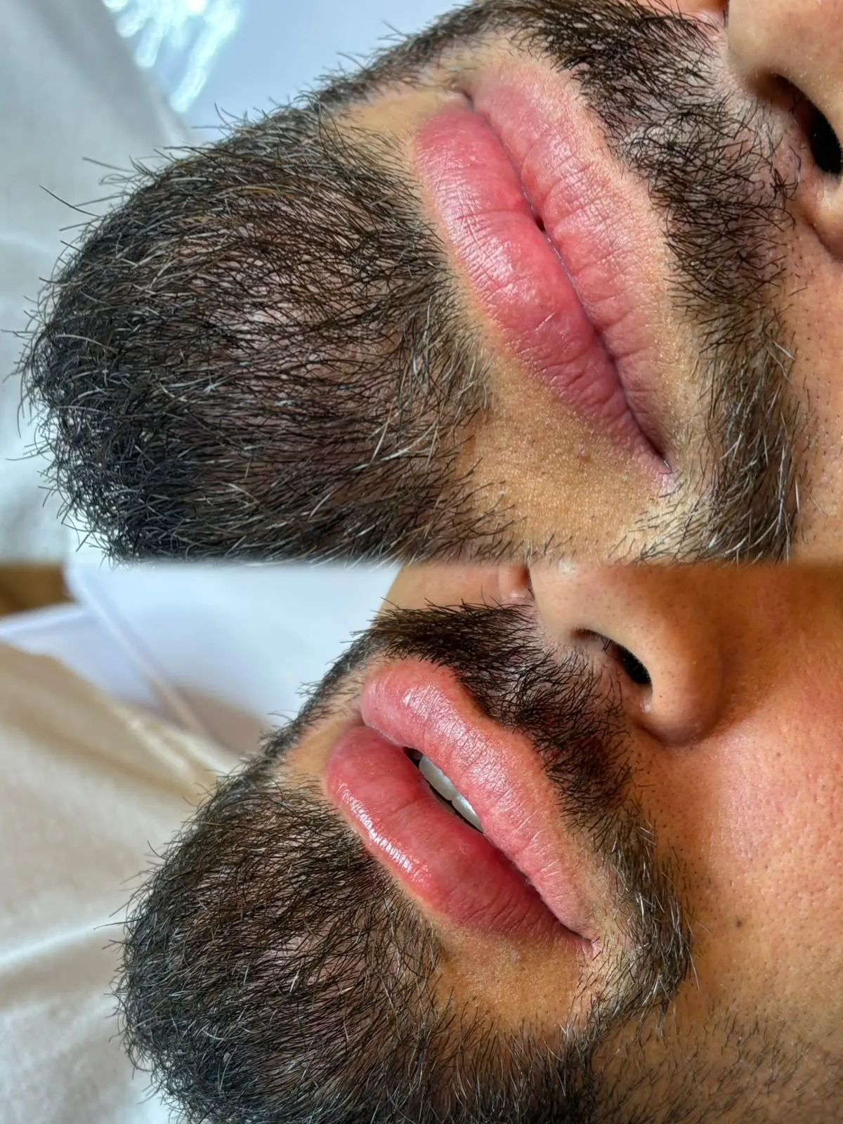 Antes e depois dos lábios de paciente masculino, vista aproximada