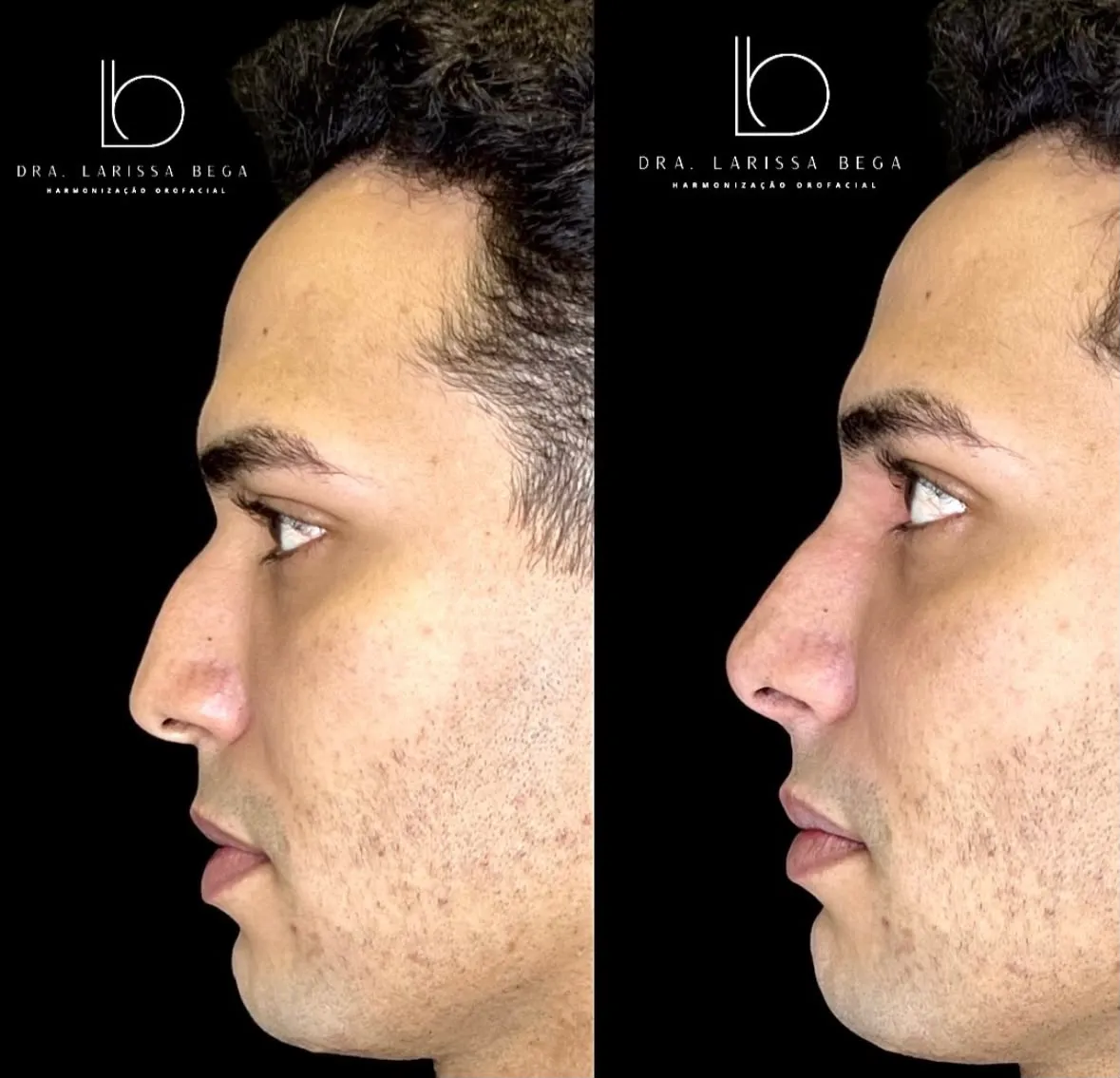 Antes e depois do perfil nasal de paciente masculino, vista lateral