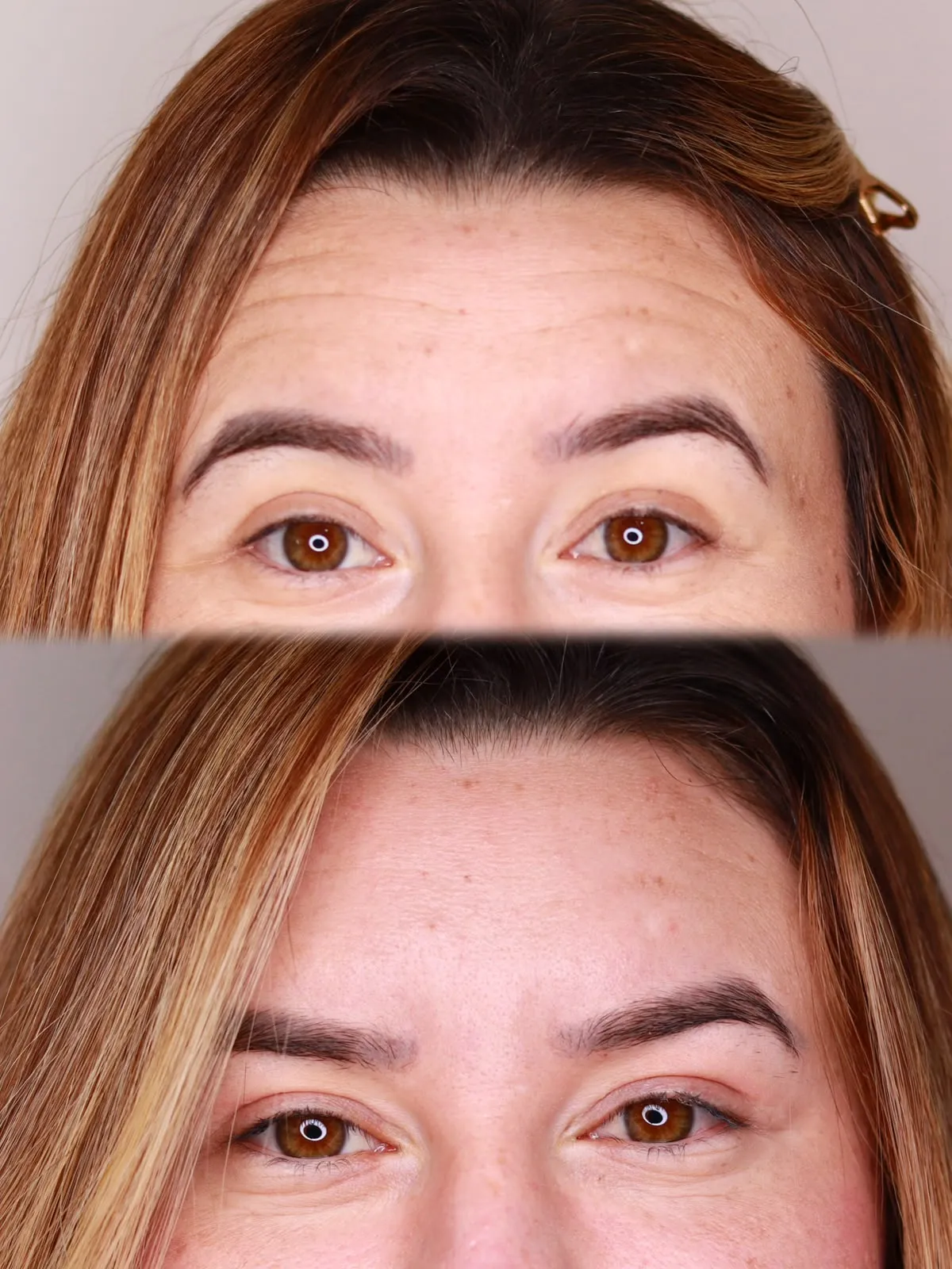 Antes e depois da região da testa e dos olhos de paciente feminina